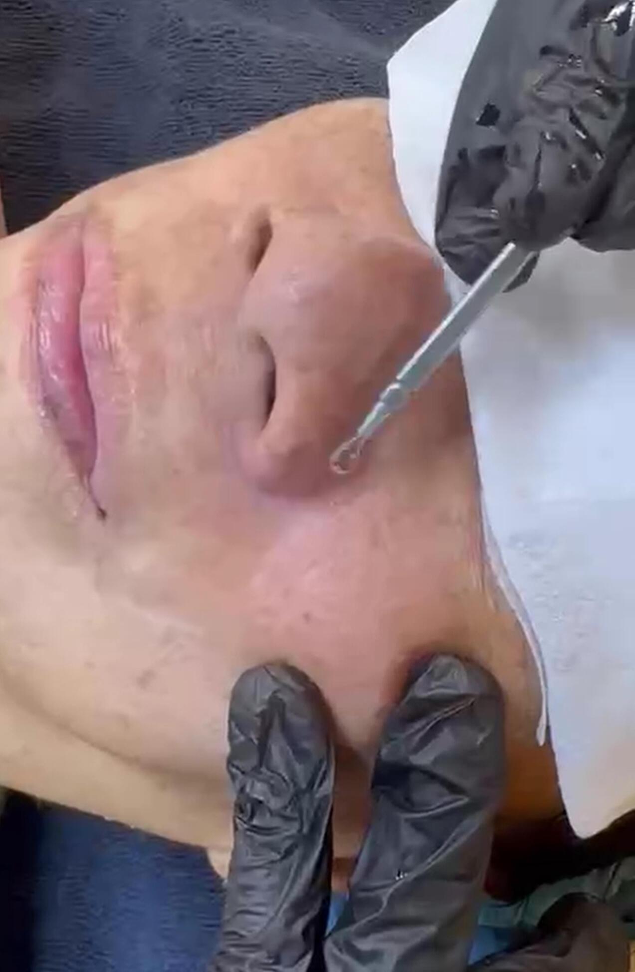 Blackheads removal