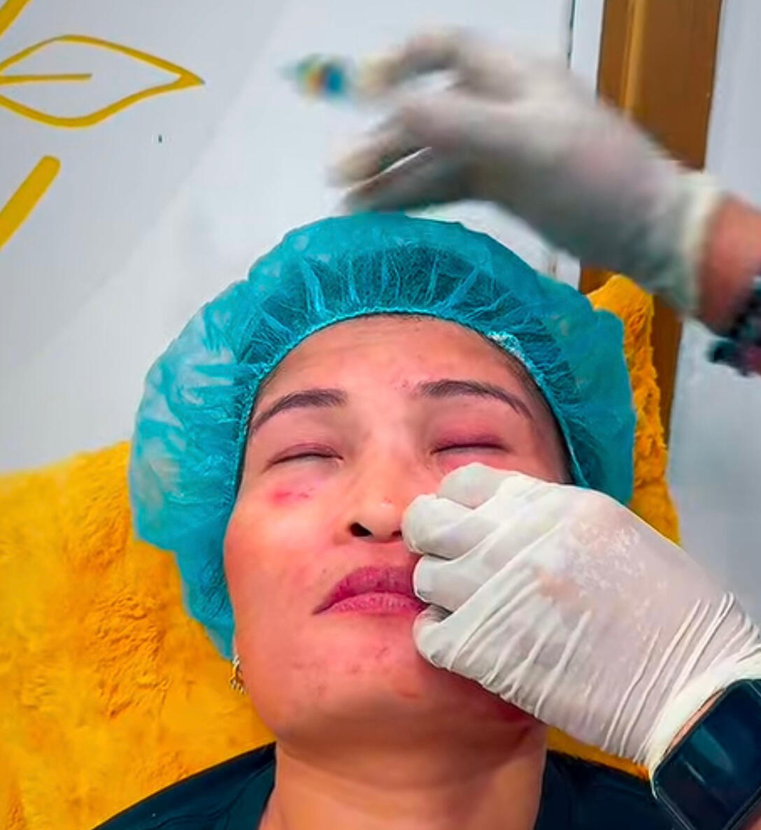 Eyebag removal